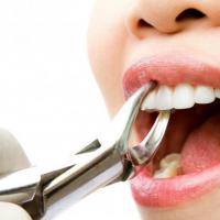 When do tooth extraction occur?
