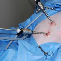 Cum este îndepărtat uterul laparoscopic?